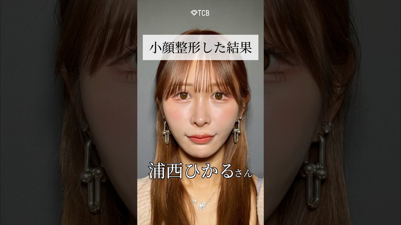 【糸リフト】小顔整形した結果 #shorts