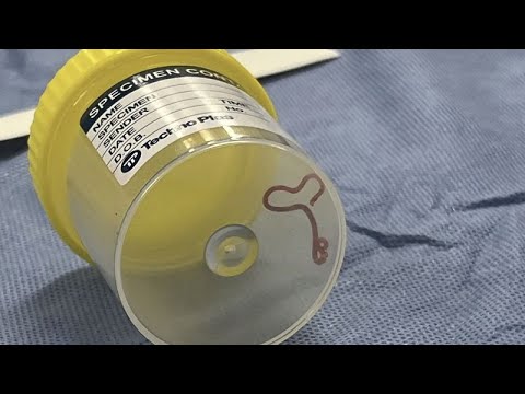 Un ver parasite extrait vivant d'une patiente australienne de 64 ans