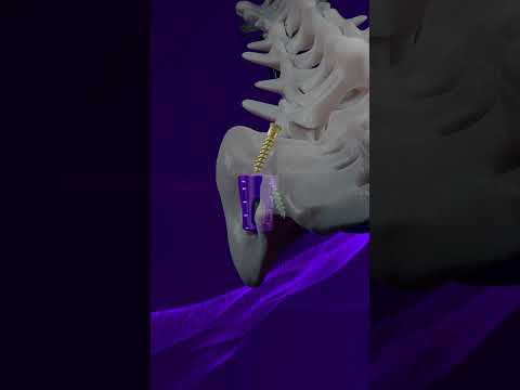 SiLO TFX™ -Bridging the gap from pain to relief