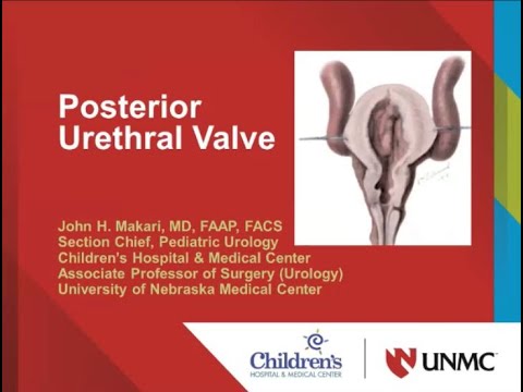 6.2.2020 PedsUroFLO Lecture - Posterior Urethral Valve