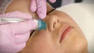 Hydroluxx Facial with oxygen infusion therapy @ Alera Med Spa