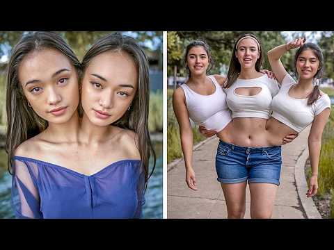 25 Conjoined Twins You Won't Believe Exist
