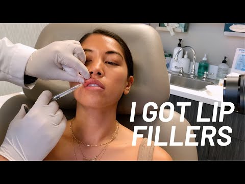 I got lip fillers for the first time!