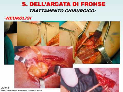 Sostituzione dellanca costo Cheboksary Sanguisughe in osteocondrosi della colonna cervicale