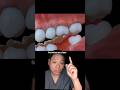 What Can Happen To Your Mouth When You Lose a Tooth!? 😁🦷 #teeth #missingtooth #tooth #toothless