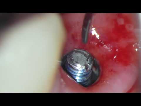Удаление сломанного винта имплантата под увеличением микроскопа