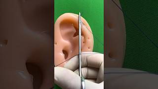 Download lagu Ear cancer excision and repair (part 3) mp3