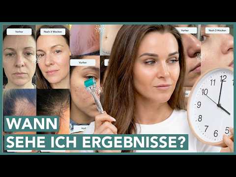 Microneedling Vorher Nachher
