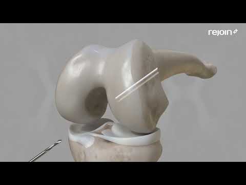 Rejoin Medical ACL reconstruction animation