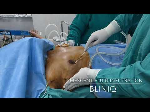 Patient Recovery Case — Video 24 (Body Sculpting)