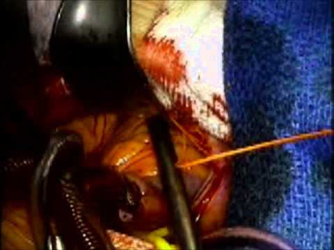 Minimally Invasive Left Atrial Myxoma Resection with "Invisible" Scar 