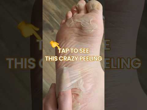 Crazy Peeling Results after Using the Plantifique Foot Peel Mask | Safe Dermatologist Tested Formula