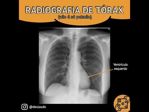 RADIOGRAFIA DE TÓRAX NÃO É SÓ PULMÃO!
