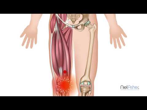 Vastus Medialis | Knee Pain | How To Find Trigger Points