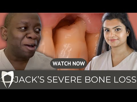 Severe bone loss around a molar tooth
