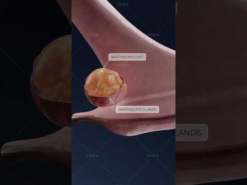 What is a Bartholin cyst and how does it affect women’s health? Gynecology in 3D with VOKA!