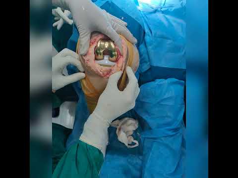 Total Knee Replacement ( Both Knees ) - Single Stage GOLD knees  - Dr. Raviraj Solanki