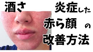 【酒さ】炎症した赤ら顔の改善方法