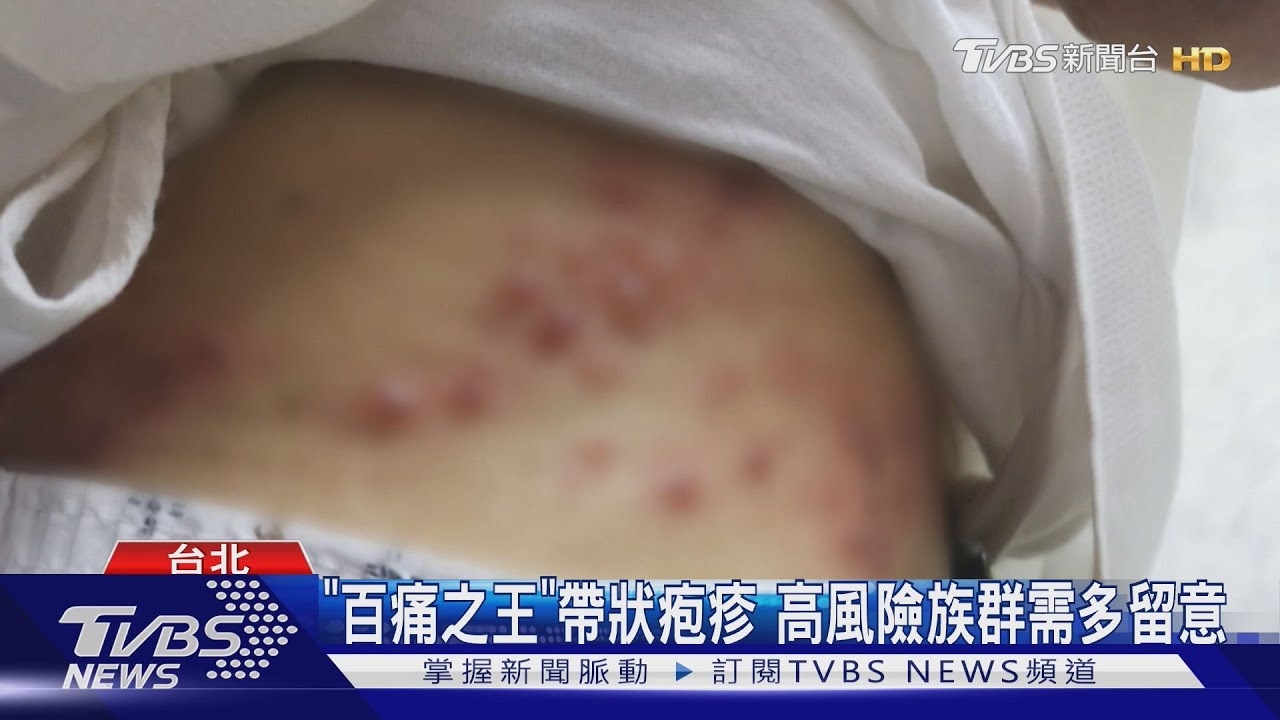 「百痛之王」帶狀疱疹　高風險族群需多留意