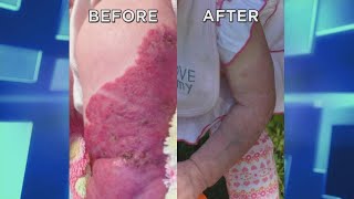 Check-Up on Bucky Covington’s Daughter’s Battle with an Infantile Hemangioma