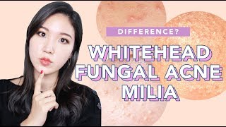 🤔Difference Between Whiteheads, Milia and Fungal Acne : What it is, How to treat
