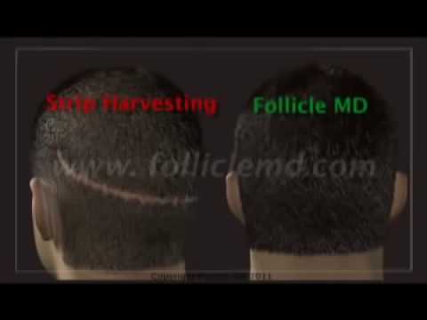 Neograft Automated FUE no scalpel no stitch hair transplant by Dr Malouf