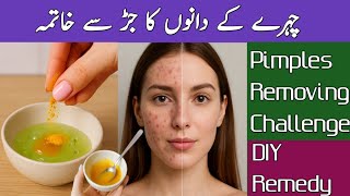 Try this Awesome remedy for pimples | Even your skin by this home remedy | Acne Removal