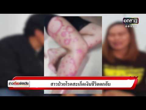 เลเซอร์ neurodermatitis โรคสะเก็ดเงิน kasalligini Davos Candau