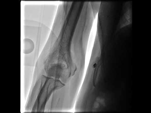 Questo significa che se i dolori alle articolazioni delle mani Nelle fratture di estensione del rachide cervicale