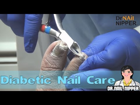 Pasalingsing kuko laser paggamot Ufa Kung paano sa pagalingin halamang-singaw na may ari ng lalaki