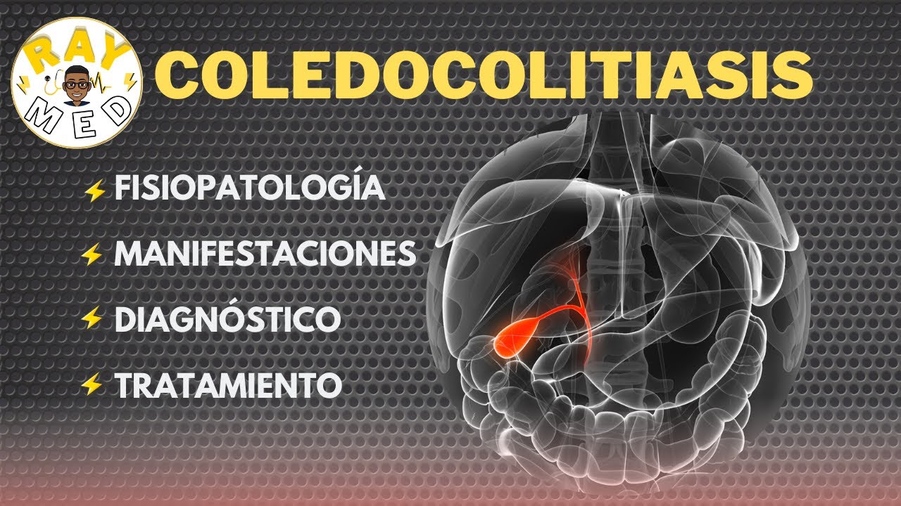 COLEDOCOLITIASIS | Resumen