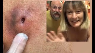 70+ Days Old Infected Cyst - Su Verhoeven&#39;s Cysts &amp; Popping