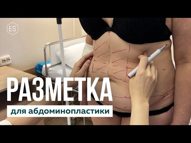 Как делается РАЗМЕТКА для АБДОМИНОПЛАСТИКИ?