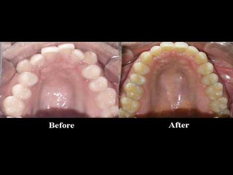 Braces or Invisalign for Crowded Teeth: A Bay Area Orthodontics Transformation