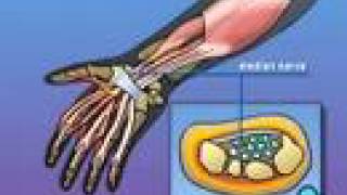 PreOp® Patient Education Carpal Tunnel Syndrome Repair