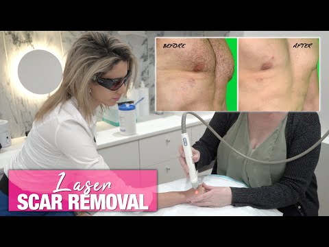 How to Remove Surgical & Acne Scars | Doctor Explains Excel V+ Skin Care