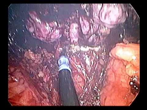 استئصال جذرى للبوستاتا عن طريق السرة SILS Radical Prostatectomy 