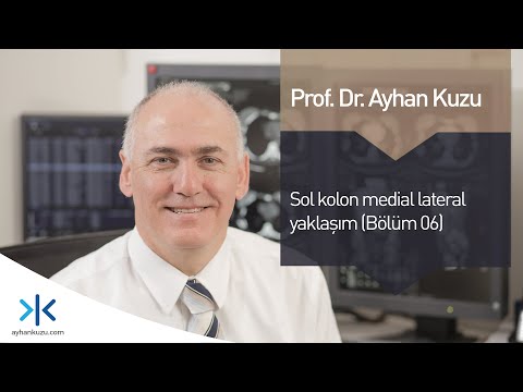 Sol Kolon Medikal Lateral Yaklaşım