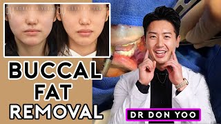 All About Buccal Fat Removal Surgery and  Recovery - Dr. Donald B. Yoo