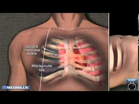 Needle Decompression Insertion Site Tutorial by Medrills