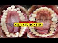 How to fix crowded teeth I Treatment for severe crooked teeth  I Orthodontic treatment