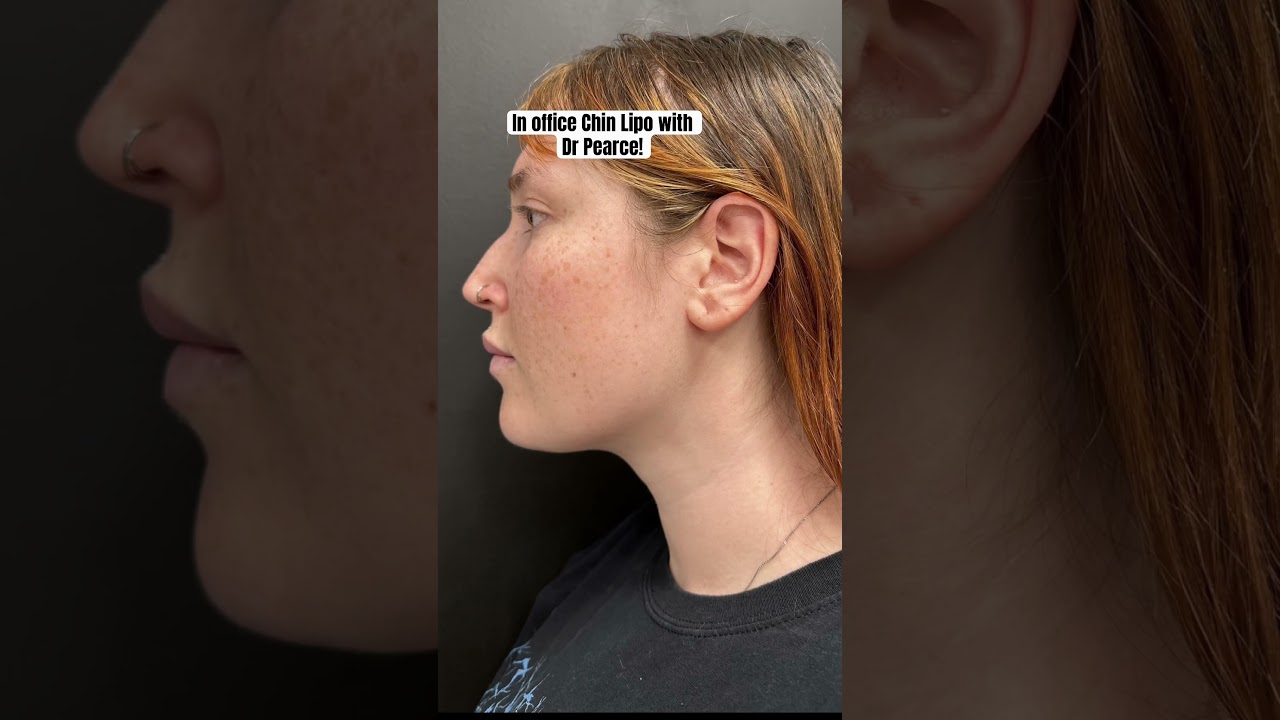 Chin Lipo Makes A Big Difference|| Austin Chin Lipo