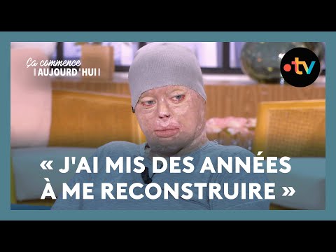 Grands brûlés : quelle vie après ? - Ça commence aujourd'hui
