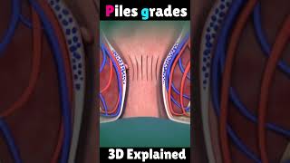 Download lagu Piles (बवासीर) grades 3d Animation #health mp3