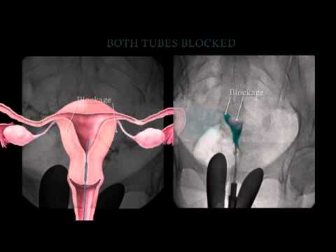 Fallopian Tube Recanalization and Selective Salpingography