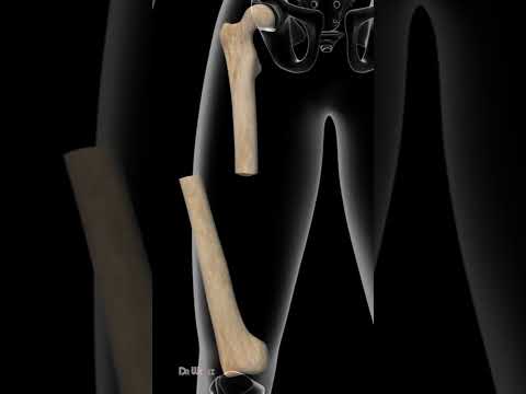4 Most Painful Femur Shaft Fractures