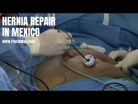 Hernia Repair in Mexico