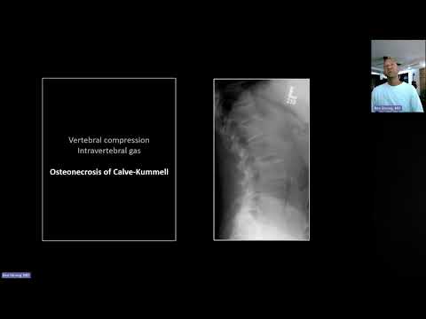 Fractures of the Thoracolumbar Spine and Shoulder | Free Radiology CME