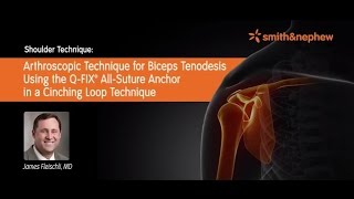 A New Technique Biceps Tenodesis