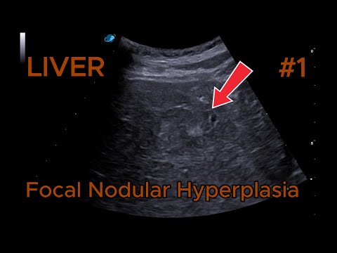Focal nodular hyperplasia - Isoechoic video preview